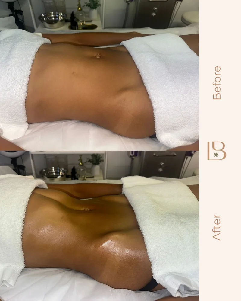 Before and after Brazilian lymphatic drainage, abdomen
