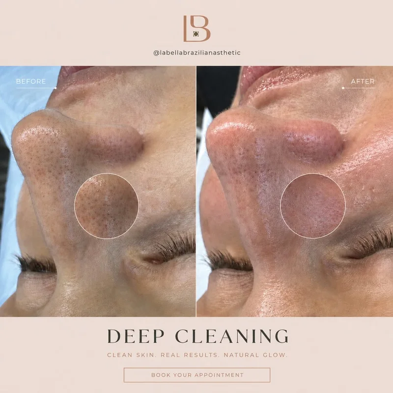 Before and after deep cleaning facial
